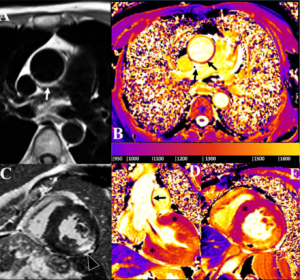 Cardiovascular magnetic resonance imaging