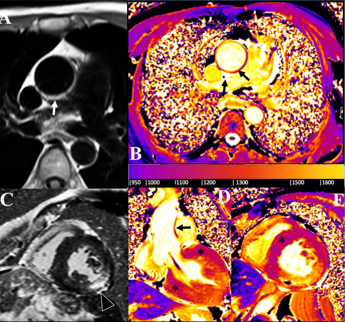 Aortopatia grave Fabry malattia